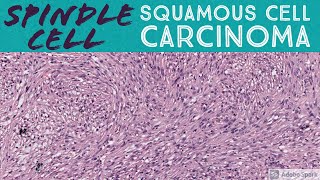 Sarcomatoid SCC Spindle Cell Squamous Cell Carcinoma 5Minute Pathology Pearls [upl. by Atnwahs]