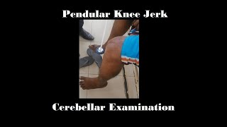 Pendular knee jerk  Cerebellar examination [upl. by Luing298]