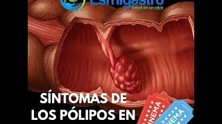 Síntomas de Pólipos en el Colon [upl. by Lepley]