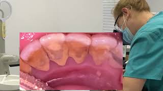 Remove tartar  teeth cleaning duet scaling [upl. by Timotheus193]