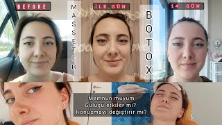 MASSETER BOTOX YAPTIRDIM  ETKİLERİ NELER   1 AYLIK SÜREÇ [upl. by Enniotna]