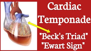 Cardiac Temponade  Becks Triad  Pulsus Paradoxus  Ewart Sign [upl. by Eyram]