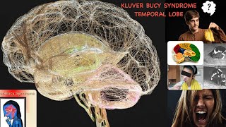 Temporal lobe and kluver bucy syndrome  HAND WRITTEN NOTES [upl. by Udela]