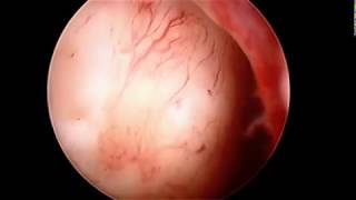 Focal Complex Atypical Endometrial Hyperplasia amp Submucosal Myoma [upl. by Bobine]