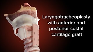 Medical Animation Anterior and Posterior Cricoid Split  Cincinnati Childrens [upl. by Noivart]