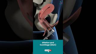 Dilation And Curettage DampC  Fertility Treatment ↪3D Medical Animation Shorts DilationampCurettage [upl. by Lenneuq300]