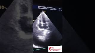 Constrictive pericarditis Echo  CP Echo  Echocardiography toacs  constrictive pericarditis [upl. by Bayless]