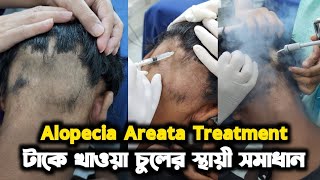 Alopecia Areata Treatment  টাকে খাওয়া চুলের স্থায়ী সমাধান [upl. by Pamella]