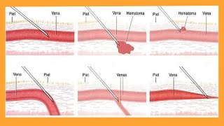 como CANALIZAR UNA VENA 🤕 10 😵 COMPLICACIONES que No sabias [upl. by Kcirred]