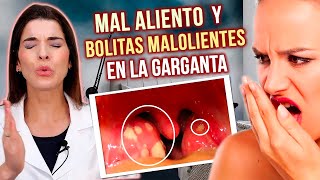 ELIMINA las Bolitas Malolientes de la Garganta y el MAL ALIENTO [upl. by Tuttle]