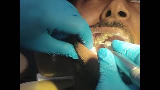 Occlusal Reduction after rctshortsvideo shortsfeed toothacherelief toothacheremedy [upl. by Eniluqaj]