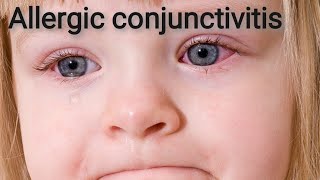 Allergic keratoconjunctivitis  Acute catarrhal keratoconjunctivitis Part 8 [upl. by Kreg]