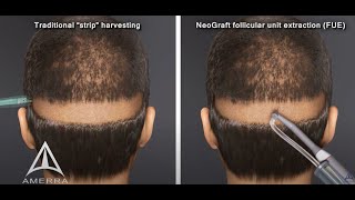 NeoGraft hair transplant procedure  animation [upl. by Annairba]