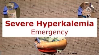 Severe Hyperkalemia Emergency [upl. by Arriek]