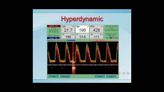 Esophageal Doppler Interpretation [upl. by Senilec]