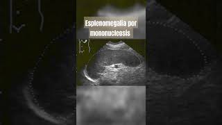 Esplenomegalia por mononucleosis infecciosa [upl. by Atipul]