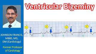 Ventricular Bigeminy [upl. by Caddaric]