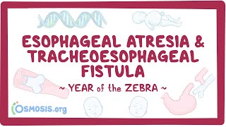 Esophageal atresia amp tracheoesophageal fistula Year of the Zebra [upl. by Pasadis78]