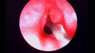 Endoscopic cricoid split [upl. by Bradman]