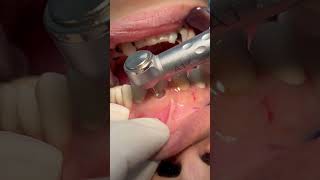 Cleaning deep tooth caries dental [upl. by Gytle]