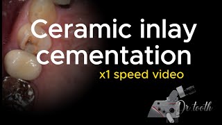 Ceramic inlay cementation procedure X1 speed 세라믹 인레이 세팅 과정 [upl. by Dermott]