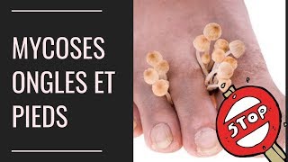 Mycoses des pieds et des ongles  Larme absolue pour sen débarrasser rapidement [upl. by Burck]