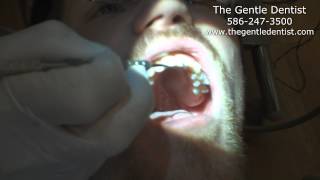 Shelby Township Dentist Repairs Broken Front Teeth [upl. by Temirf54]