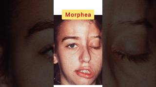 Morphea ऐसी बिमारी है जो चेहरे के आधे मांस को सूखा सकती है morphea scleroderma systemicsclerosis [upl. by Adni]