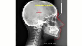 Lateral Cephalometric radiograph tracing Ceph tracing 2 [upl. by Felten]