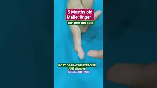 Mallet finger hand physiotherapy movement advice pain finger stiffness thumb bpi mnd old [upl. by Zoie]