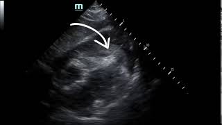 Pericardial clot US annotated JETem 2019 [upl. by Eustatius]