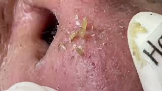 Nose Blackheads Removal with Haris Beauty  2022 [upl. by Akimet]