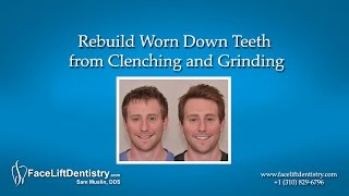 Rebuild Worn Down Teeth from Clenching and Grinding [upl. by Pavkovic]