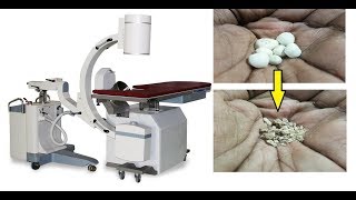 What is ESWL Lithotripsy [upl. by Betteanne]