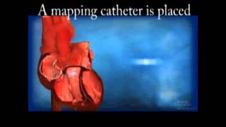 Ventricular Tachycardia VT Ablation [upl. by Janith]