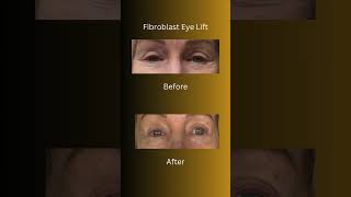 Fibroblast  Eye Lift  fibroblast plasmapen orangecounty [upl. by Bussy]