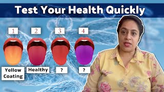 Homeopathy Geographic Tongue Disease Understanding in Hindi  Dr Taranjeet Kaur [upl. by Babita]