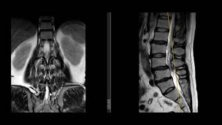 VERTEBRA TRANSICIONAL LUMBOSACRA EN RM  LUMBARIZACION DE S1 VS SACRALIZACION L5 [upl. by Tannenwald]