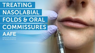 Using Dermal Fillers to Fill and Smooth Smile Lines  AAFE [upl. by Pauly645]