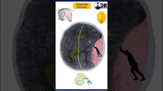 HEMATOMA EPIDURAL  HEMATAMOS INTRACRANEALES  Medicina en 1 minuto Shorts [upl. by Dewayne64]