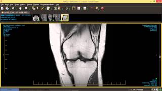 How to Read Knee MRI [upl. by Patrica]