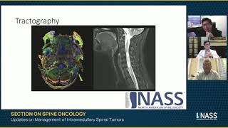 Updates on Management of Intramedullary Spinal Tumors [upl. by Riggall]