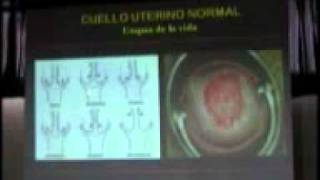 PRIMER CURSO DE COLPOSCOPÍA  TALLER CERVIX NORMAL METAPLASIA ESCAMOSA [upl. by Nisse756]