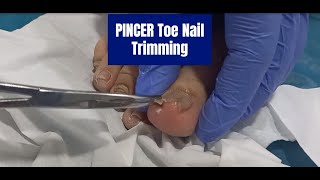 NonInvasive Pincer Uncut Toenail Trimming Effective Techniques and Prevention [upl. by Leboff]