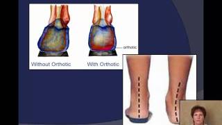 Plantar Fasciitis explained by a Podiatrist [upl. by Wadesworth]