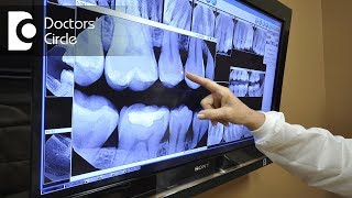 How safe are dental x rays  Dr Shyam Padmanabhan [upl. by Nort]