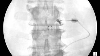 Lumbar Transforaminal Epidural  Neurogram to Epidural with an Extra Millimeter  ThePainSourcecom [upl. by Rostand]