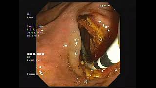 LARGE MULTIPLE CBD STONESCRE14mmPrimary sessionERCPADPKD Patient [upl. by Jarid]