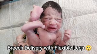 Breech delivery of Newborn baby with Flexible Legs just after birth [upl. by Anilrats3]