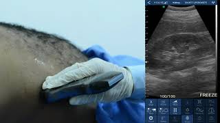 Renal Ultrasound Protocol with Eagleview Ultrasound Scanner [upl. by Ahsas275]